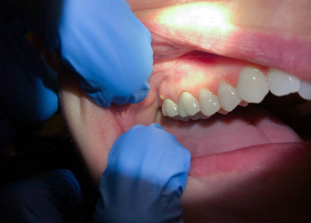 Best Emergency Gum Treatment in Caddo, OK